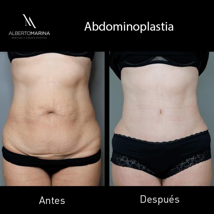 ABDOMINOPLASTIA-IHC-1-AÑO_01