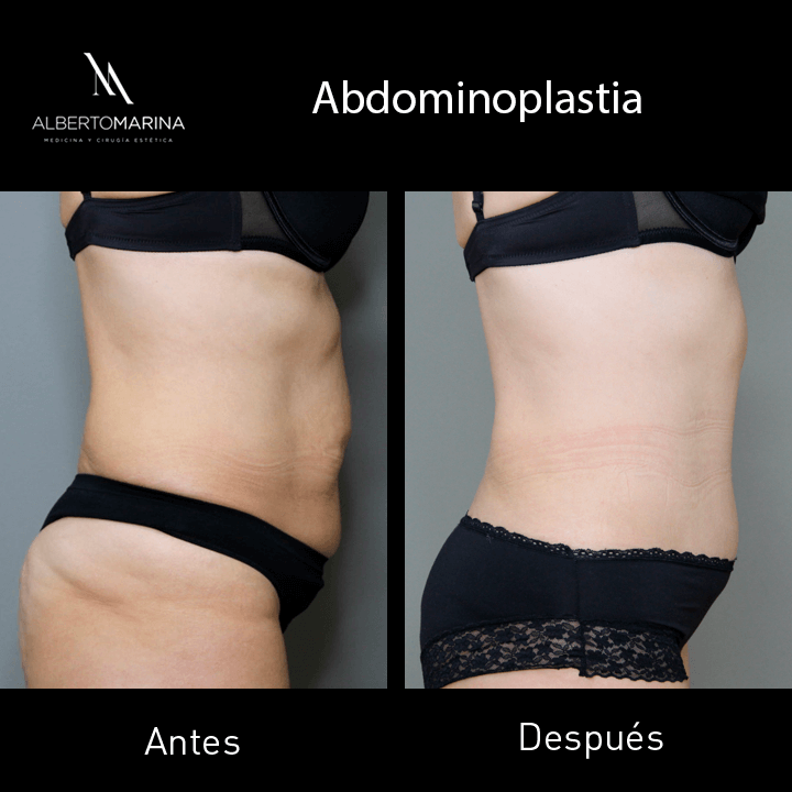 ABDOMINOPLASTIA-IHC-1-AÑO_02