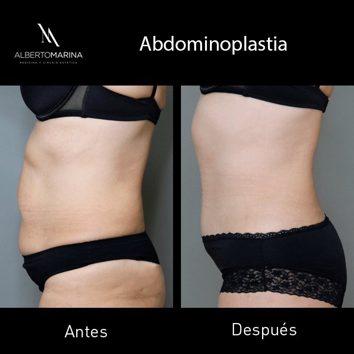 ABDOMINOPLASTIA-IHC-1-AÑO_03